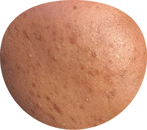 Acne scars closeup